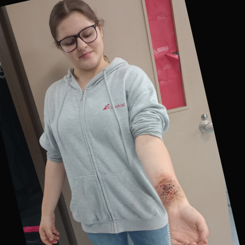 student showing her fake burn on her arm