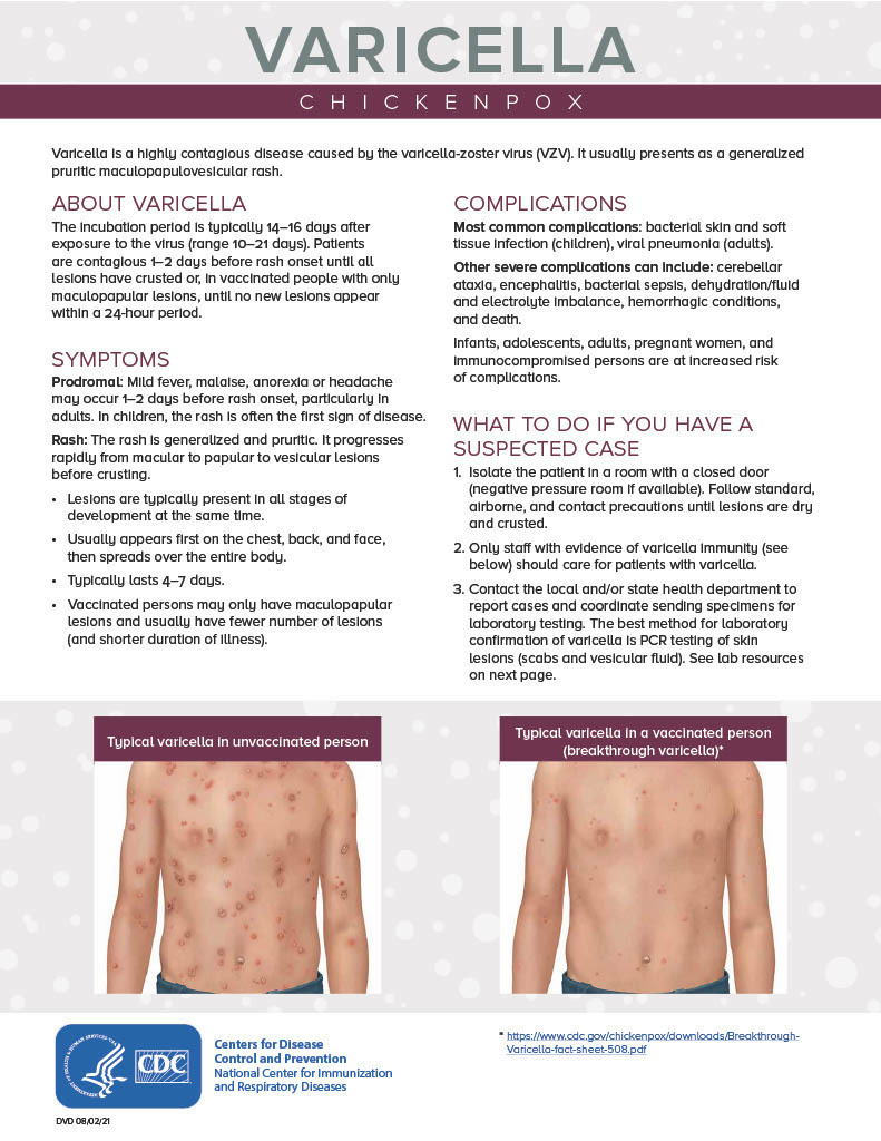 Page 1  Chicken Pox