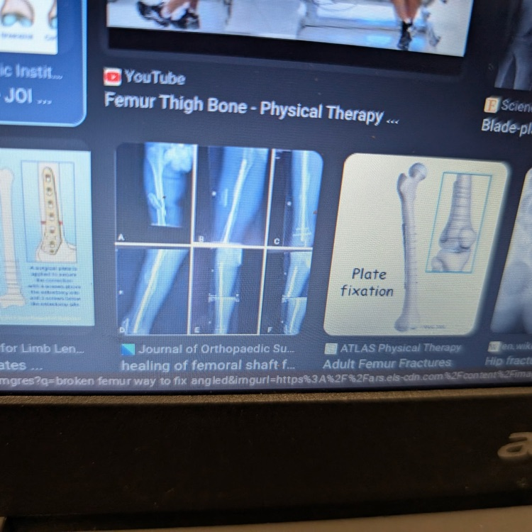 femur 