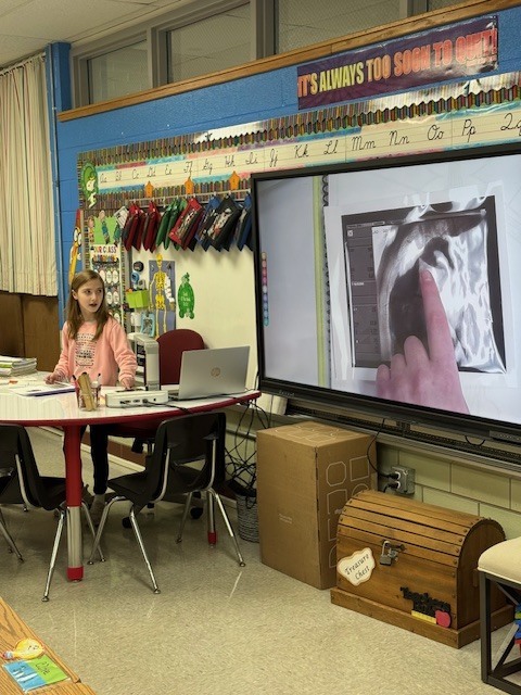 Sharing the valve stent and what it does.