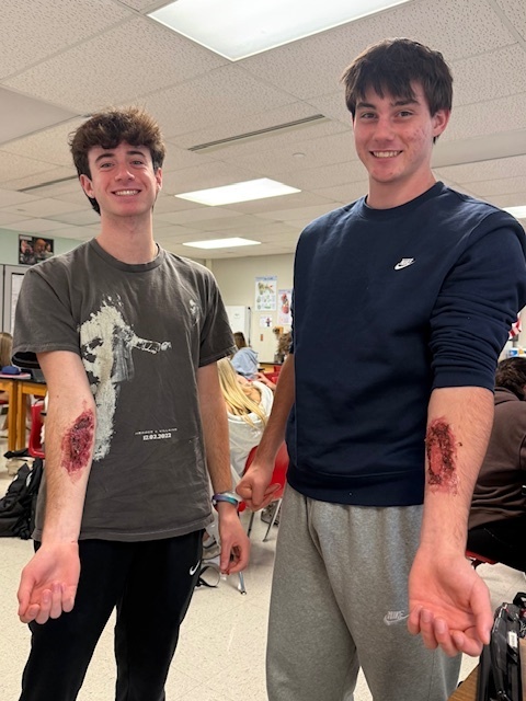 Two high school students showing fake burn marks