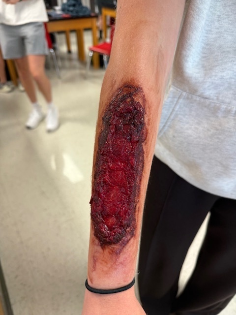 A very dark looking flesh wound