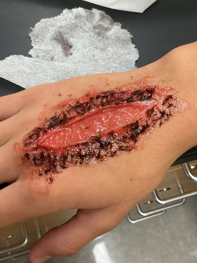 Another wound on the hand.  