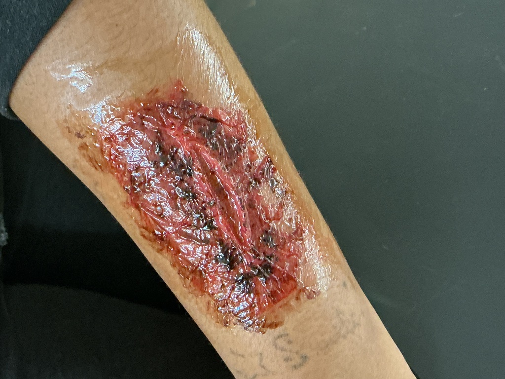 A wound on the arm.  