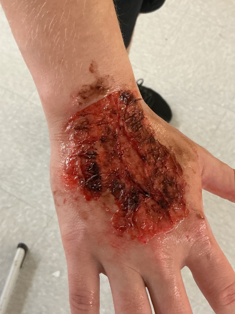 A wound on the hand.  