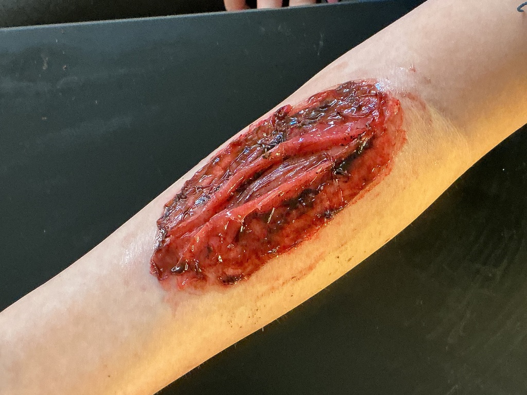 A wound created on the arm.  