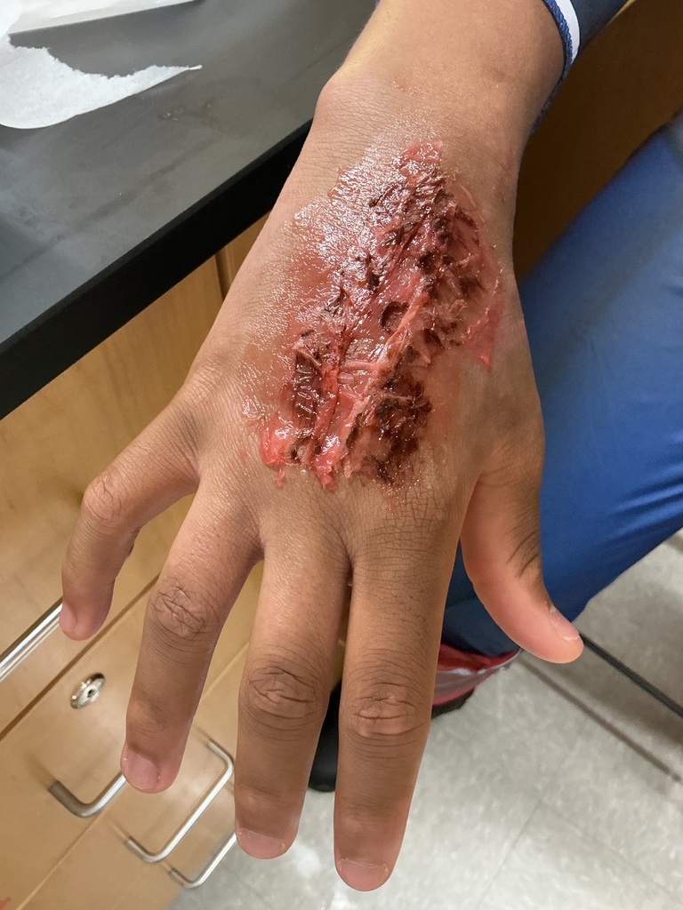 A wound created on the hand.  